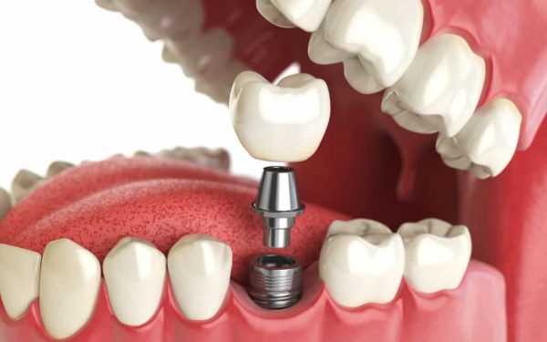 Качественное протезирование зубов в СПб с индивидуальным подходом к каждому пациенту